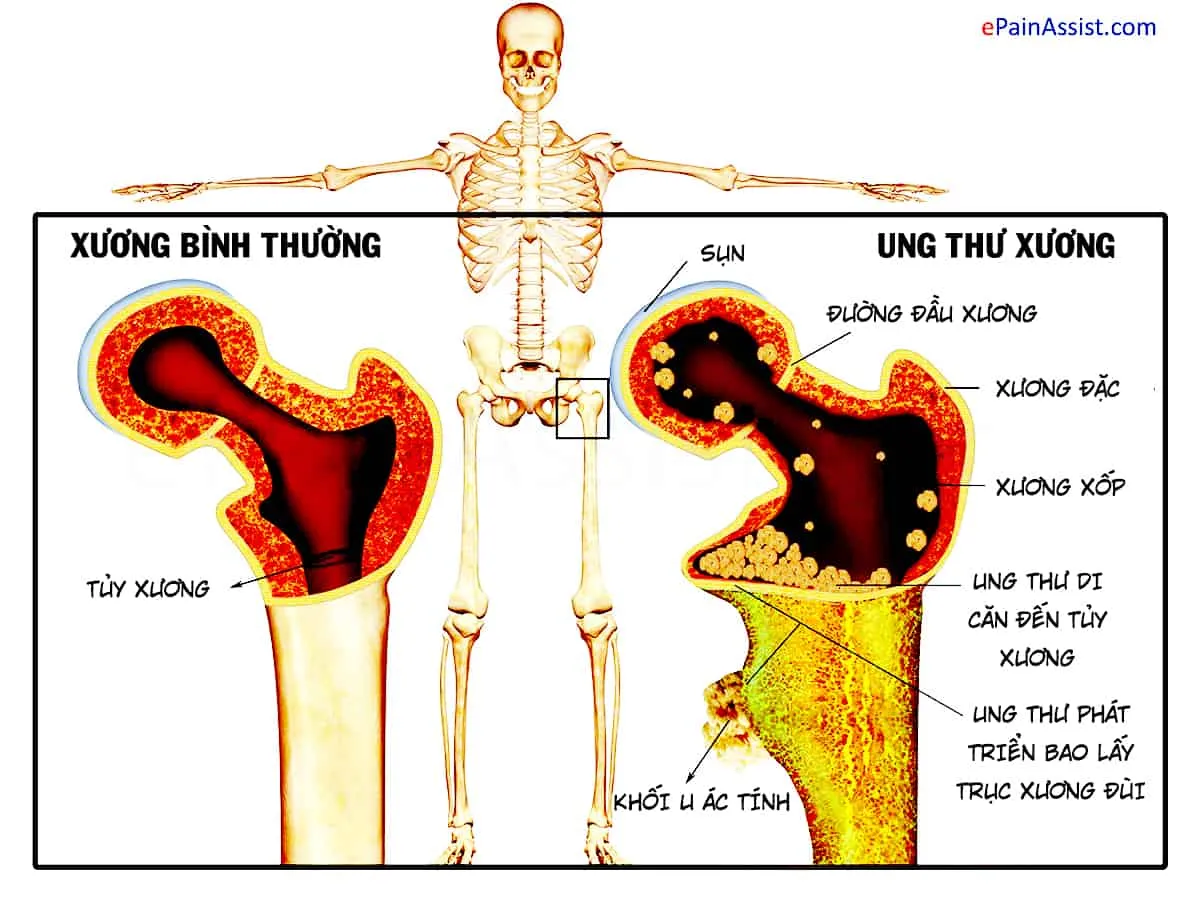 Tương lai nào cho người bị ung thư xương giai đoạn cuối?