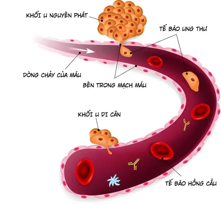 Tương lai nào cho người bị ung thư xương giai đoạn cuối?