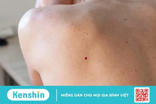 U mạch anh đào có đáng sợ như bạn nghĩ? Có nên điều trị?