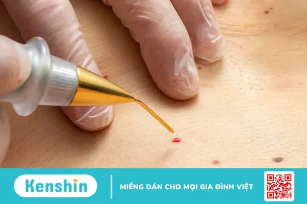 U mạch anh đào có đáng sợ như bạn nghĩ? Có nên điều trị?