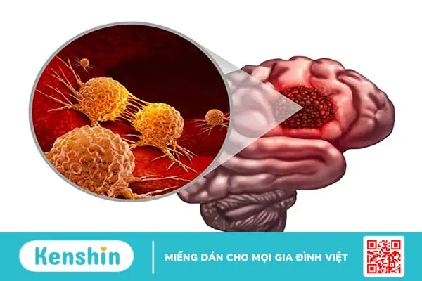 U nguyên bào thần kinh đệm là gì?