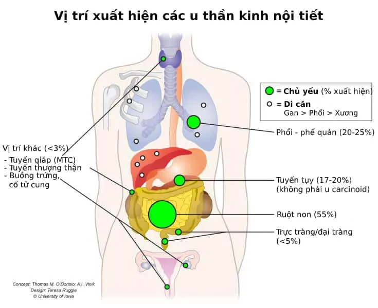 U thần kinh nội tiết