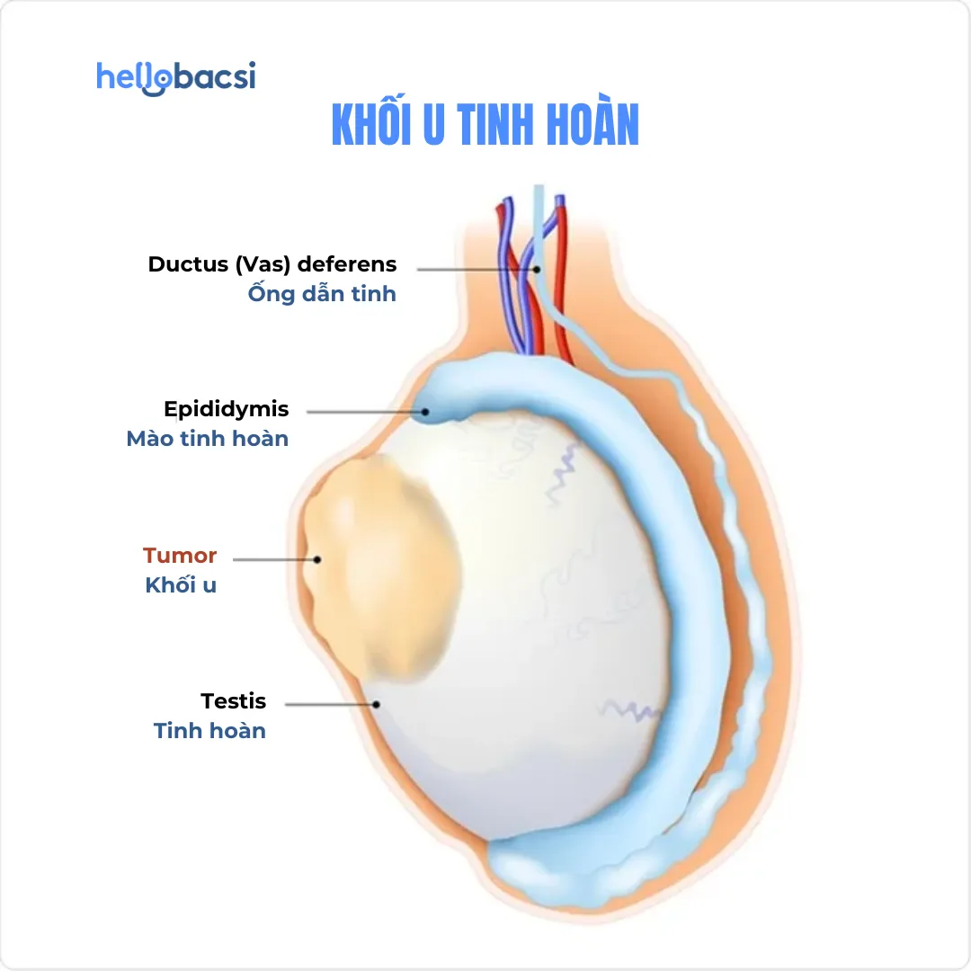 U tinh hoàn là gì? Khối u tinh hoàn có phải là ung thư không?