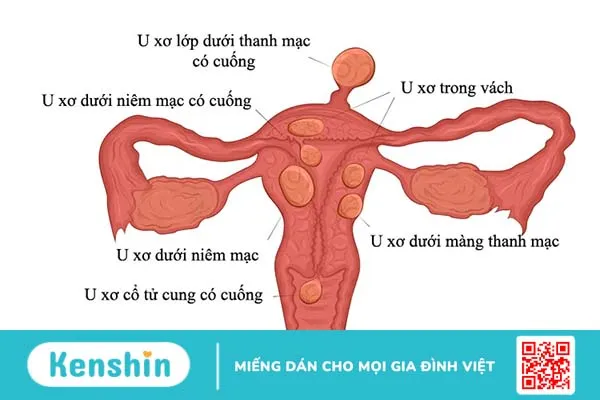 U xơ cổ tử cung là gì? U xơ cổ tử cung có nguy hiểm không?