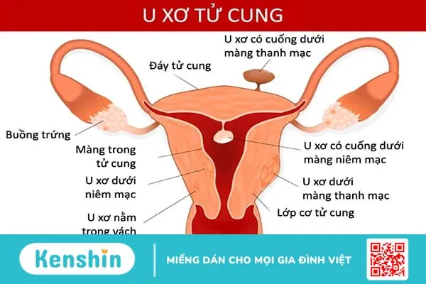 U xơ tử cung có nên uống sữa đậu nành? Biết để kiểm soát bệnh