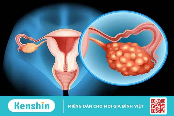 Ung thư buồng trứng giai đoạn 3