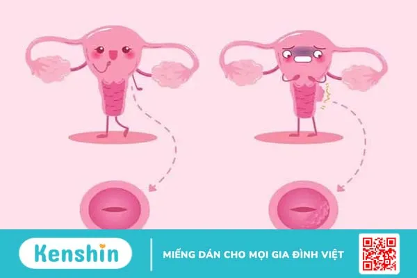 Ung thư cổ tử cung giai đoạn đầu là gì? Triệu chứng và cách điều trị