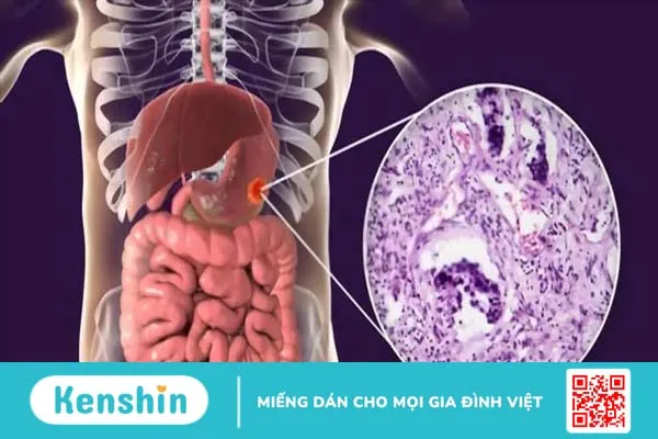 Ung thư dạ dày có lây không? Những lầm tưởng và cách phòng ngừa