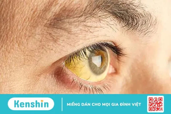 Ung thư gan di căn sống được bao lâu?