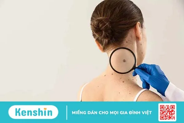 Ung thư hắc tố da giai đoạn cuối: Điều trị và tiên lượng