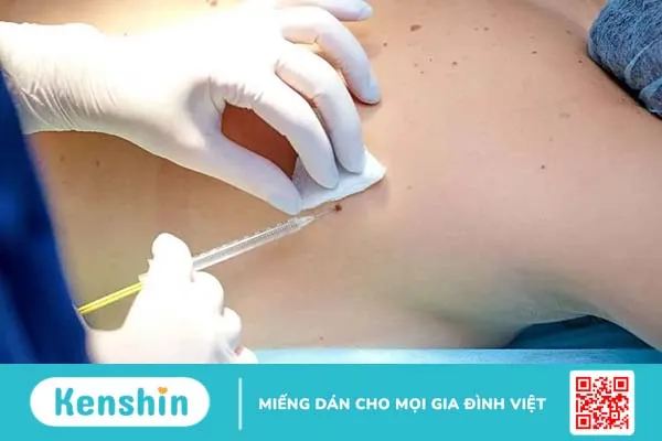 Ung thư hắc tố da giai đoạn cuối: Điều trị và tiên lượng