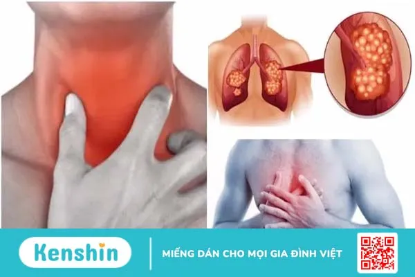 Ung thư phổi có di truyền không? Hãy khám phá sự thật!