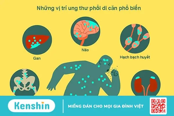 Ung thư phổi có thể di căn đến những cơ quan nào?