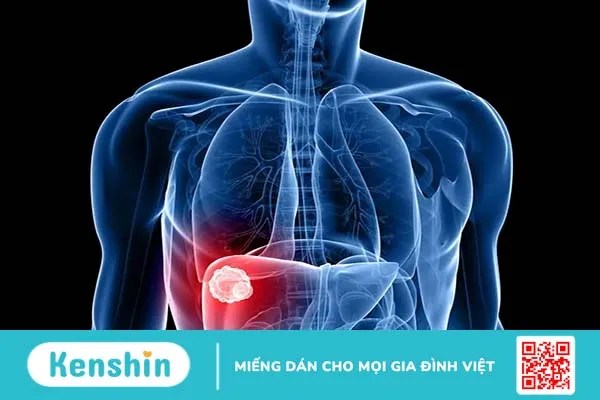 Ung thư phổi di căn gan là gì? Triệu chứng và cách điều trị