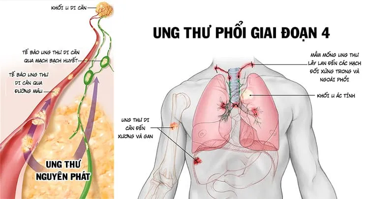 Ung thư phổi di căn xương: Tiên lượng sống và cách điều trị