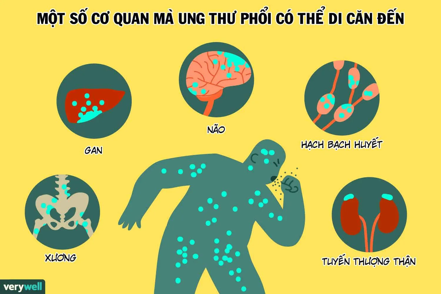 Ung thư phổi di căn xương: Tiên lượng sống và cách điều trị