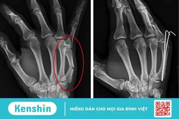 Ung thư phổi di căn xương: Tiên lượng sống và cách điều trị