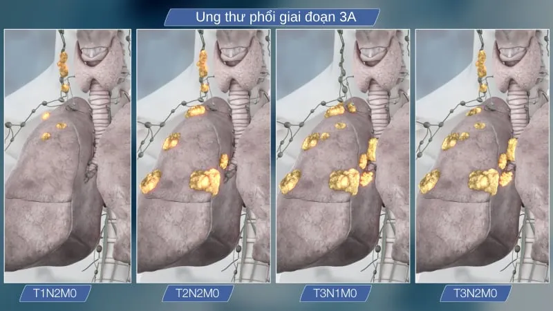 Ung thư phổi giai đoạn 3 (III)