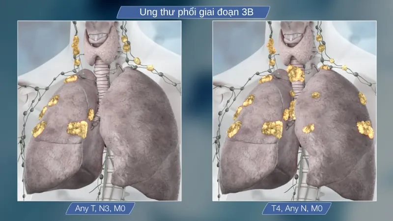 Ung thư phổi giai đoạn 3 (III)