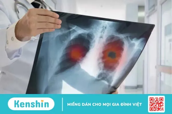 Ung thư phổi giai đoạn 4 có phải là giai đoạn cuối không, sống được bao lâu?