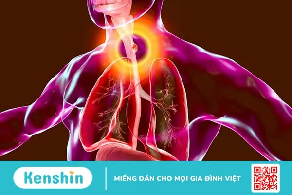 Ung thư thực quản giai đoạn 1