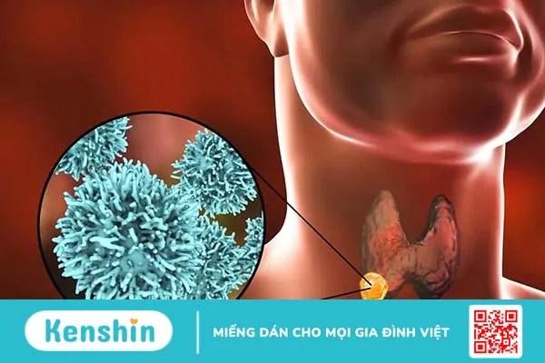 Ung thư tuyến giáp giai đoạn 3