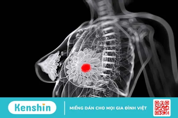 Ung thư vú di căn xương sống được bao lâu?