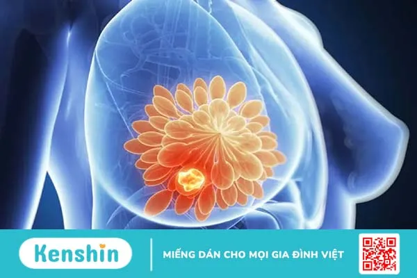 Ung thư vú giai đoạn 2 sống được bao lâu?