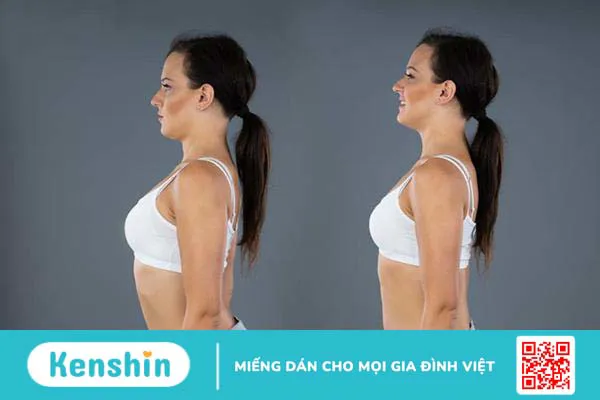 Ưỡn cột sống (võng lưng) là gì và điều trị bằng cách nào?