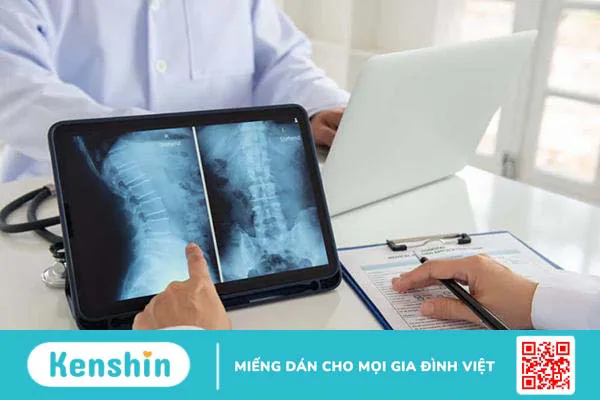 Ưỡn cột sống (võng lưng) là gì và điều trị bằng cách nào?