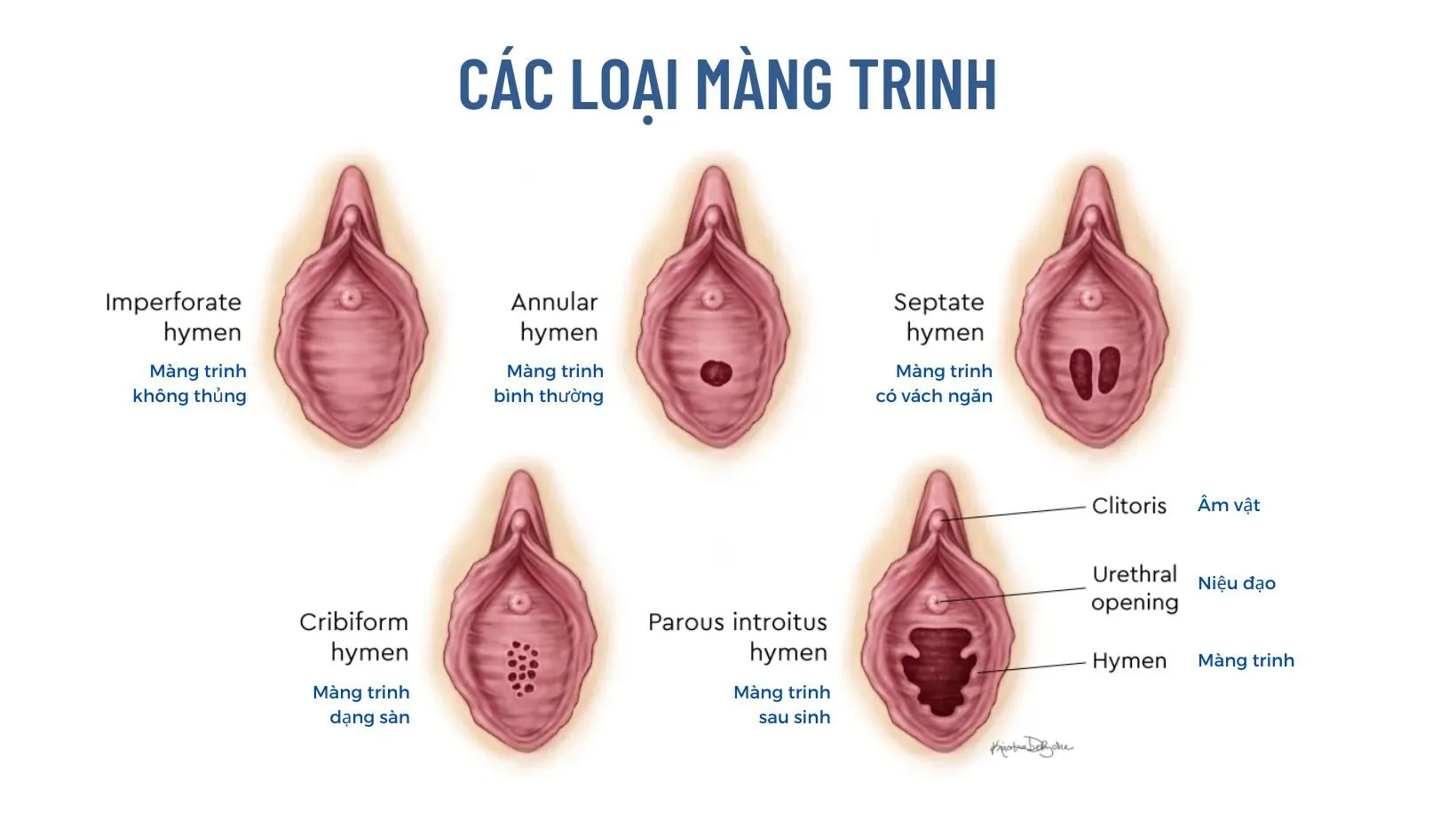 Vá màng trinh là gì? Tác hại và rủi ro của việc vá màng trinh