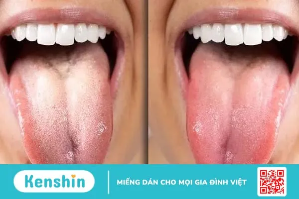 Vạch trần 5 nguyên nhân gây bệnh lưỡi trắng và cách điều trị hiệu quả