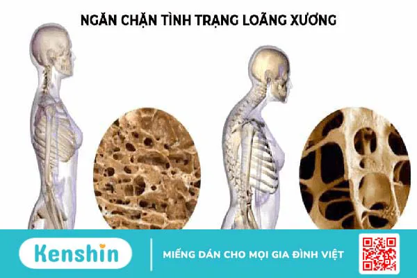 Vai trò của vitamin D trong ngăn ngừa loãng xương ở phụ nữ mãn kinh