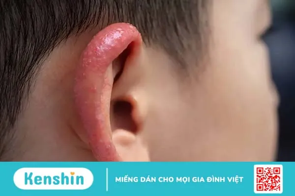 Vành tai bị sưng ngứa: Nguyên nhân do đâu và cách xử lý nhanh