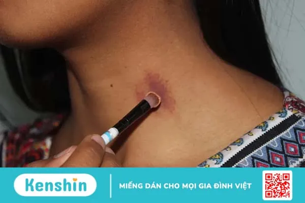 Vết cắn yêu hickey có nguy hiểm không?