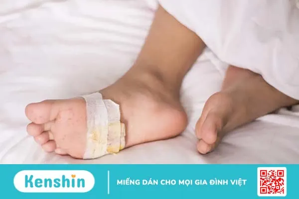 Vết loét tiểu đường: Hiểu rõ để chăm sóc nhẹ nhàng hơn