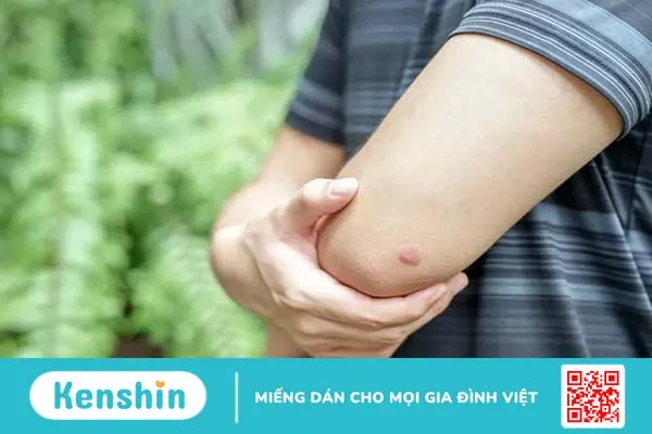 Vết nhện cắn có nguy hiểm không, xử lý thế nào?