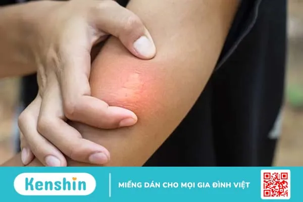 Vết ong đốt bị ngứa phải làm sao? 10 cách làm giảm ngứa khi bị ong đốt