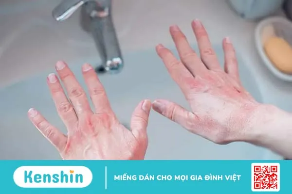 Vì sao da bị dị ứng khi gặp thời tiết lạnh? Xử lý và phòng ngừa thế nào?