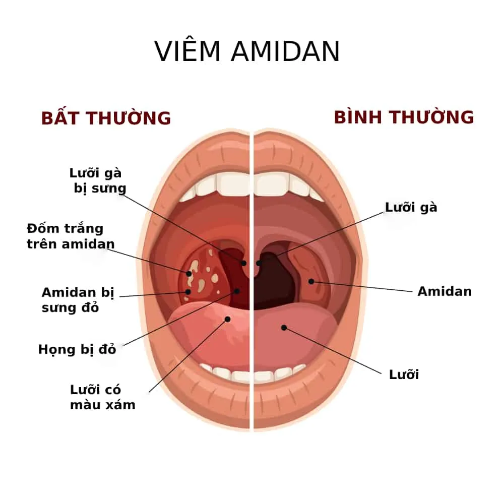 Viêm amidan hốc mủ là gì? Có cắt được được không?