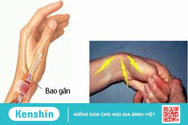 Viêm bao gân