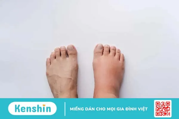 Viêm cầu thận