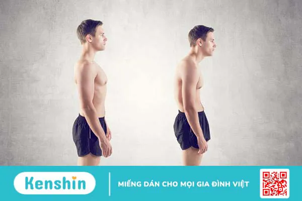 Viêm cột sống dính khớp: bệnh nguy hiểm nhưng ít người hiểu rõ