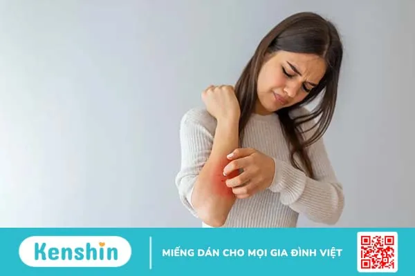 Viêm da cơ địa có lây không, cách chữa trị như thế nào?