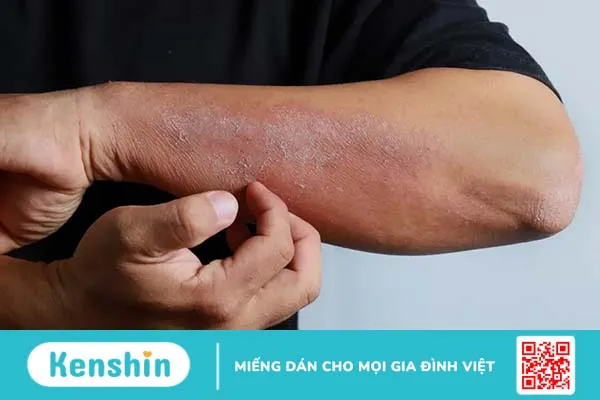 Viêm da cơ địa có lây không, cách chữa trị như thế nào?