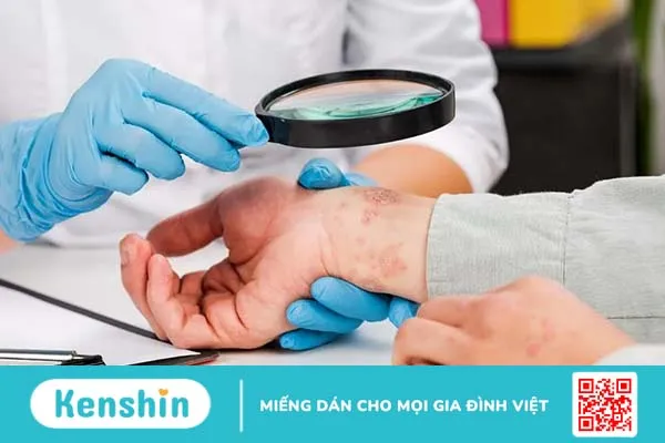 Viêm da cơ địa có lây không, cách chữa trị như thế nào?