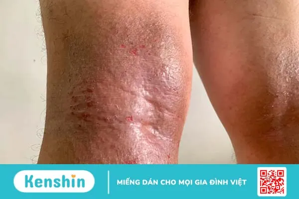 Viêm da cơ địa ở chân: Cách chung sống “hòa bình”với bệnh