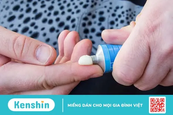 Viêm da cơ địa ở người lớn: Nguyên nhân, triệu chứng và cách điều trị