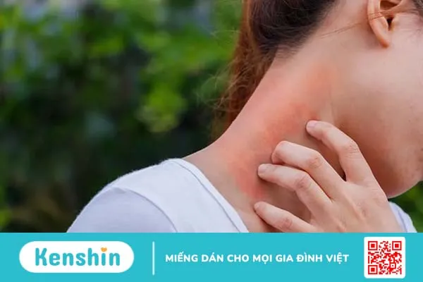 Viêm da cơ địa ở người lớn: Nguyên nhân, triệu chứng và cách điều trị