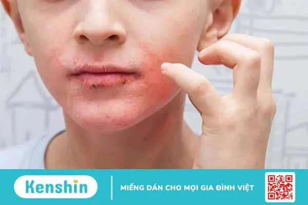 Viêm da dị ứng ở mặt: Bạn cần biết gì?